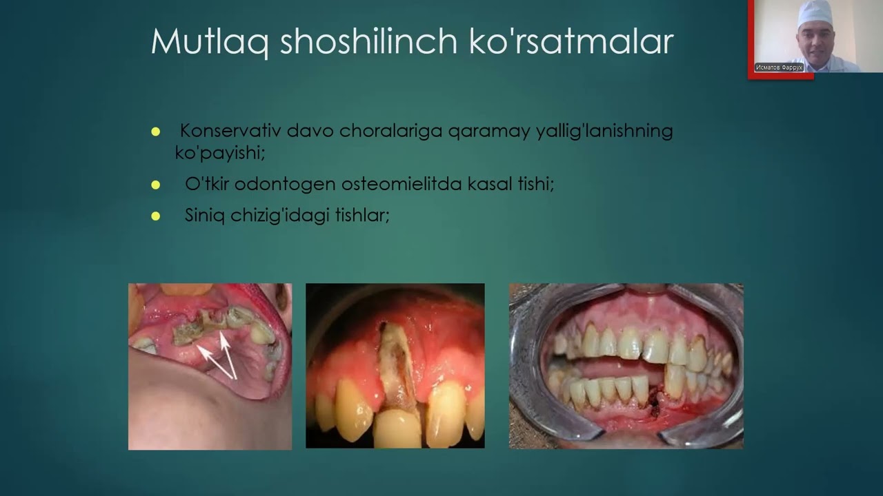 Bolalarda tishlarni olish texnikasi