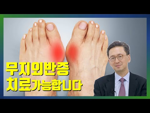 무지외반증 치료 가능합니다