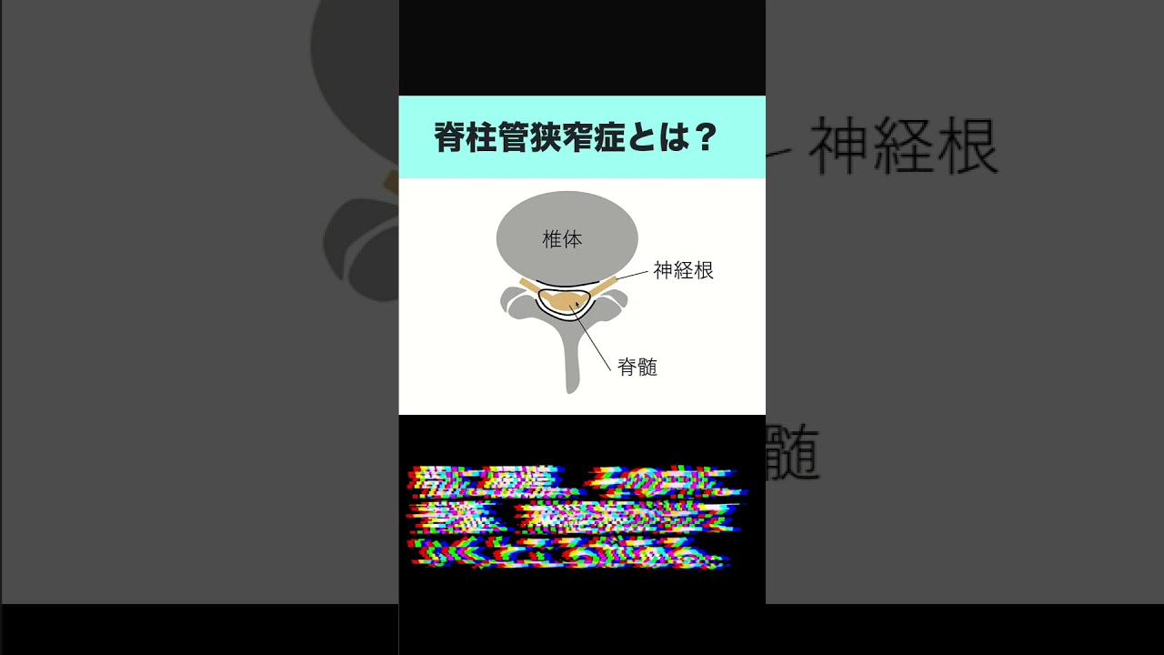 脊柱管狭窄症とその原因【頸椎MRI/腰椎MRI画像診断のコツ】#shorts