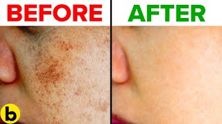 10 Home Remedies To Get Rid Of Face Pigmentation For Good