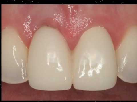 Dental Implants in the Smile Zone- Part 3
