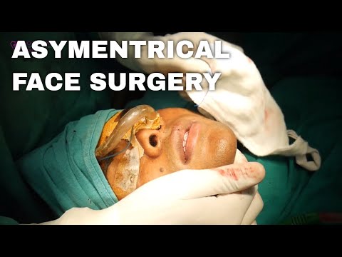 Lower Facial Asymmetrical Correction