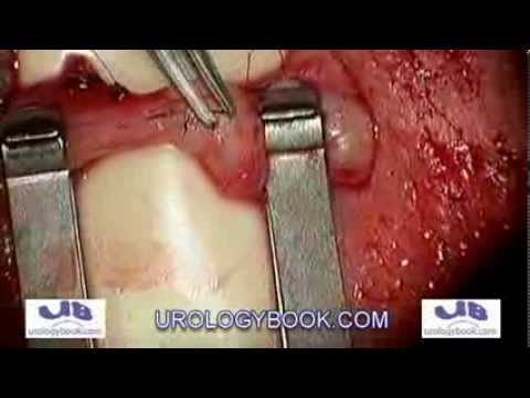 Vasovasostomy (Vasectomy Reversal) With Operating Microscope