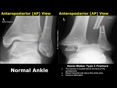 Danis-Weber Classification of Ankle Fractures X-Ray Normal Vs Abnormal Images | Fibular Fractures