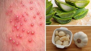 7 Powerful Home Remedies to Get Rid of Folliculitis