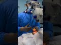 Cataract Eye Surgery Cataract Cataractsurgery Eyehospital Eyesurgery Eyecare Cataracteye