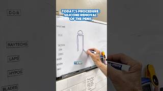 Download lagu How Dr. Katzen removes silicone from the penis mp3