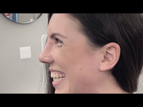 Recovery Day 10 After Closed Scarless Rhinoplasty | Dr. med. Simon Zimmermann