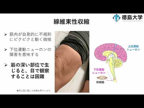 【徳島大学定例記者会見②(令和4年7月26日)】筋超音波による筋委縮性側索硬化症（ALS）早期診断マーカーの開発に成功