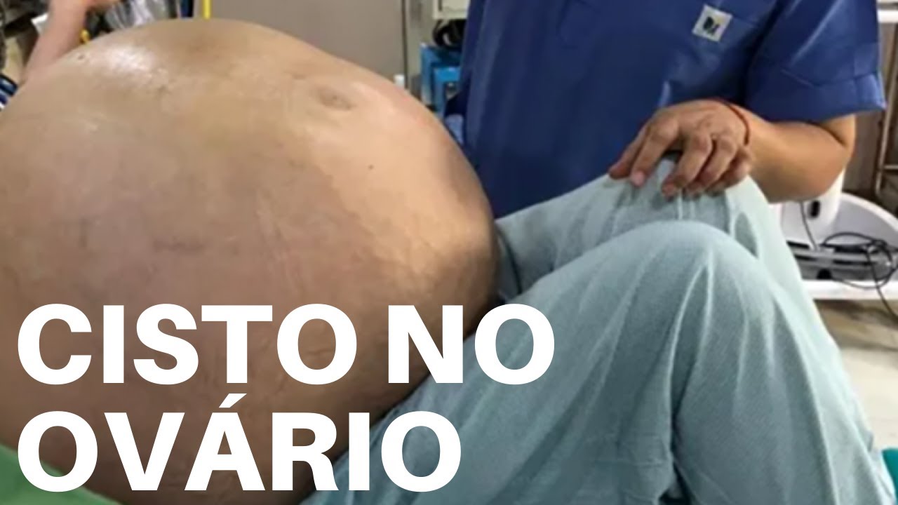 CISTO NO OVÁRIO: OS 5 TIPOS QUE TODOS PRECISAM SABER.