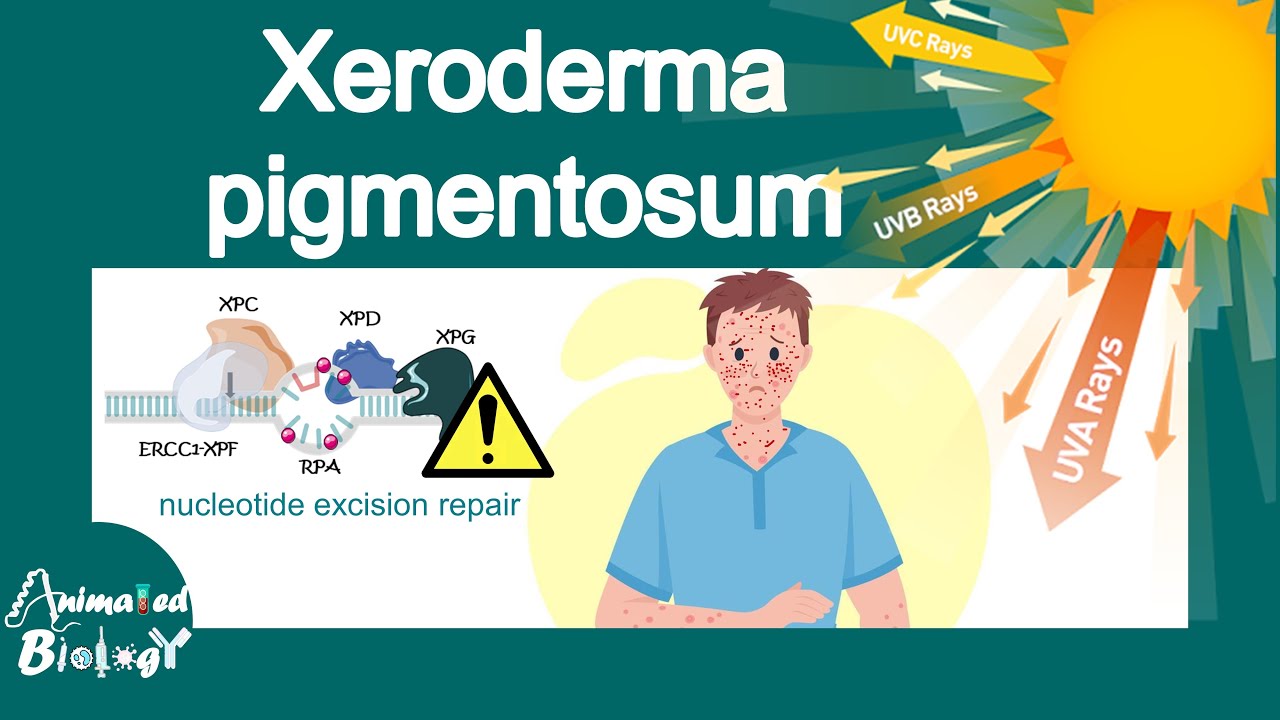 Xeroderma pigmentosum | What is the main cause of xeroderma pigmentosum? | treatment of XP | USMLE