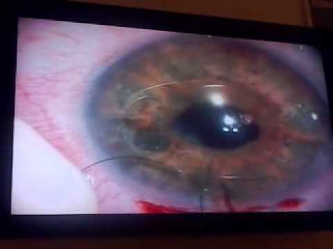 Hogyan látja az ember látássérült