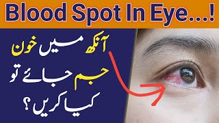 Blood Spot in the Eye | आंख में खून का धब्बा | Aankh Mein Khoon Aana