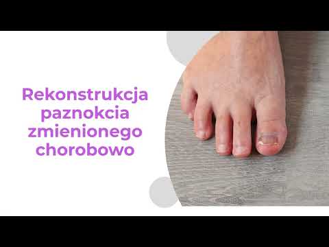 Podologia Nowak Katarzyna Nowak-Kącka - video