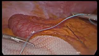TPEA Lifter - Hernia Mesh Fixation