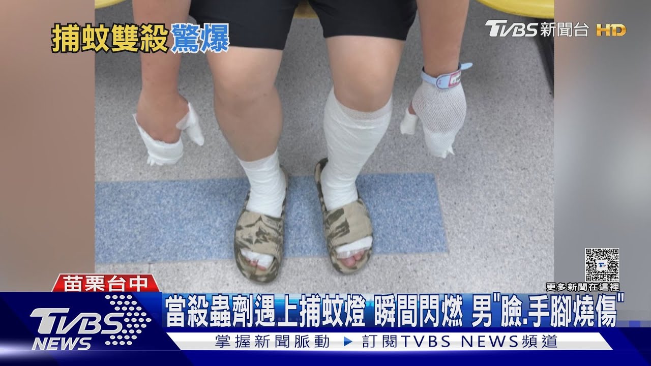 當殺蟲劑遇上捕蚊燈 瞬間閃燃 男臉手腳二度灼傷 痛苦難行