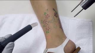 Removing a cross and flower tattoo on ankle
