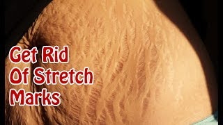 10 Ways To Get Rid Of Stretch Marks On Thighs Fast/Erase Stretch Marks in 4 Weeks | Quick & Easy |