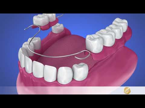 Zahnersatz: Brücke mit Klammer