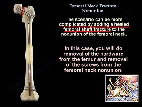 Femoral Neck Fracture Nonunion - Everything You Need To Know - Dr. Nabil Ebraheim