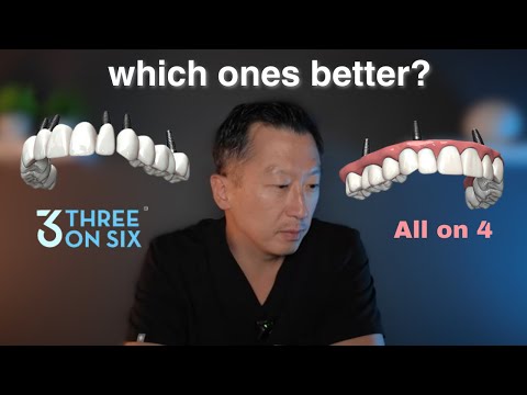All On 4 VS. 3 On 6 - Dentist Reacts