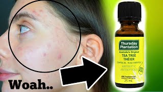 I TESTED TEA TREE OIL ON MY PIMPLES FOR ONE WEEK || DOES THI