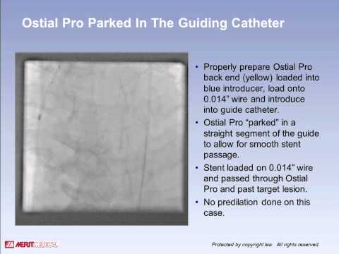 Ostial Pro® Stent Positioning System Left Main #1 Case Study