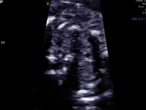 Fetal heart Academy - HLHS AoS #1, four chamber view sweep to 3VTV