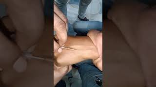 Cannulation video part 1022 #shorts #viral #hospital