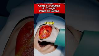 COMO É FEITA A CIURGIA DO CORAÇÃO: PONTE DE SAFENA #saude #saudavel #infarto #coração #colesterol