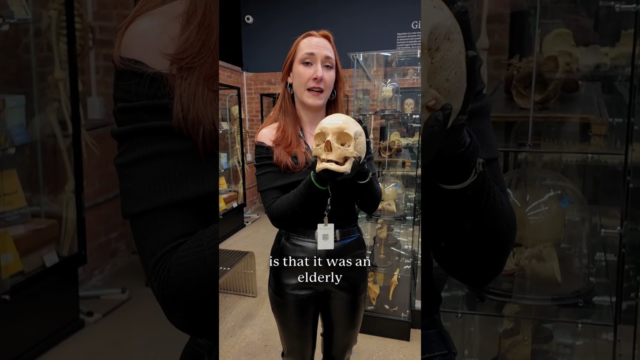 ￼ How does multiple myeloma affect bones - ￼ in depth