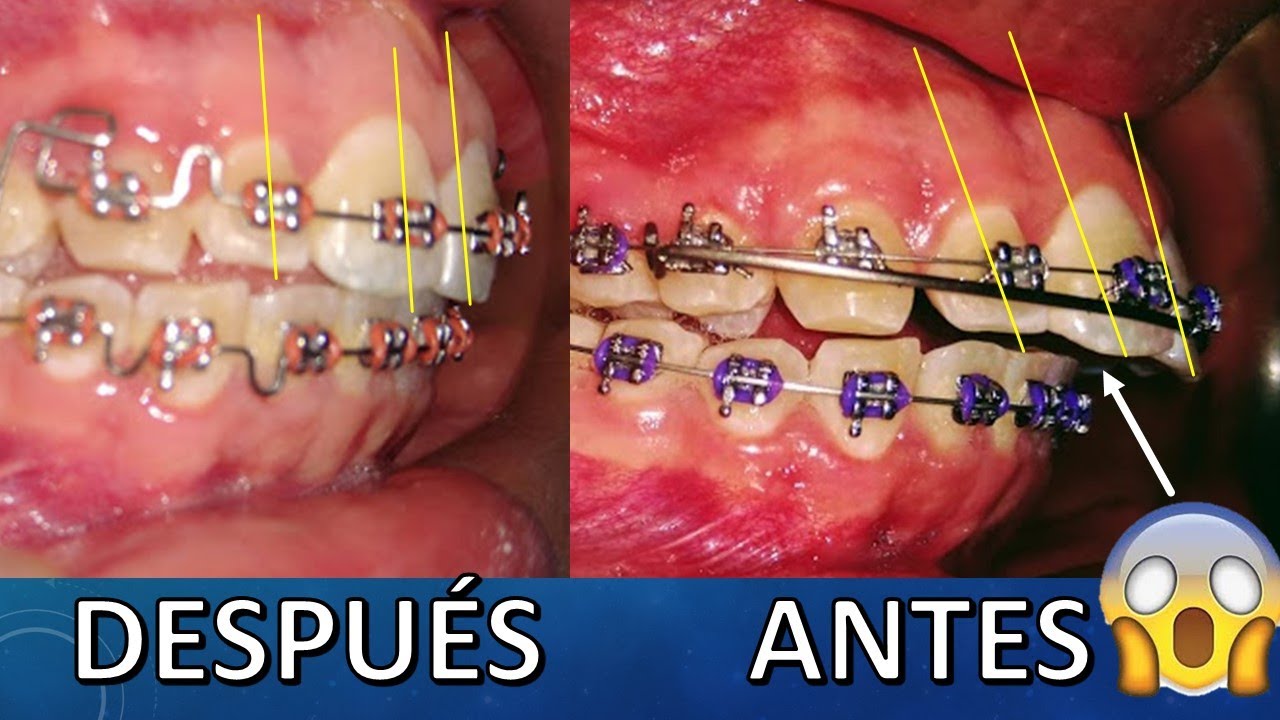 ¿Como mejorar dientes proinclinados, sin la extracción de dientes premolares en algunos casos😎✌