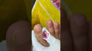 Ep_8184 *Ingrown toenail removal 👣 No..don't be rude 😄 (clip from Thailand)