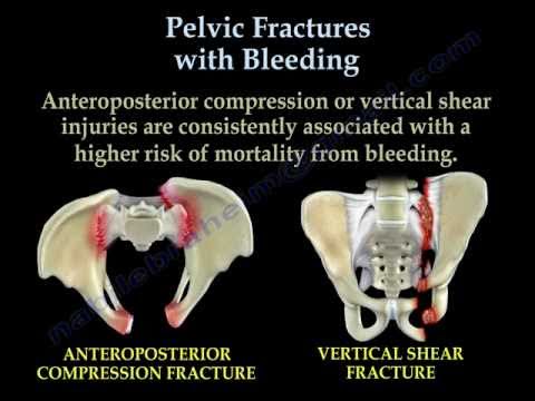 Pelvic Fractures With Bleeding - Everything You Need To Know - Dr. Nabil Ebraheim