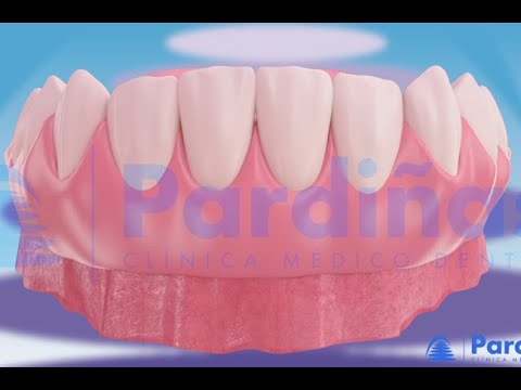 ओवरडेन्चर (overdenture) ©