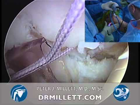 Arthroscopic Posterior Stabilization | Arthroscopic Shoulder Surgery | Shoulder Instability | Vai