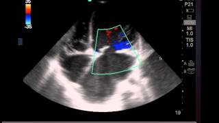 14yo Girl with Chest Pain