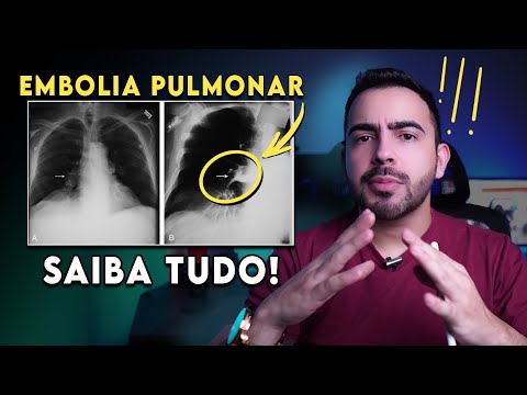 Preste atenção: 10 sinais de EMBOLIA PULMONAR! │ Médico Explica o TEP