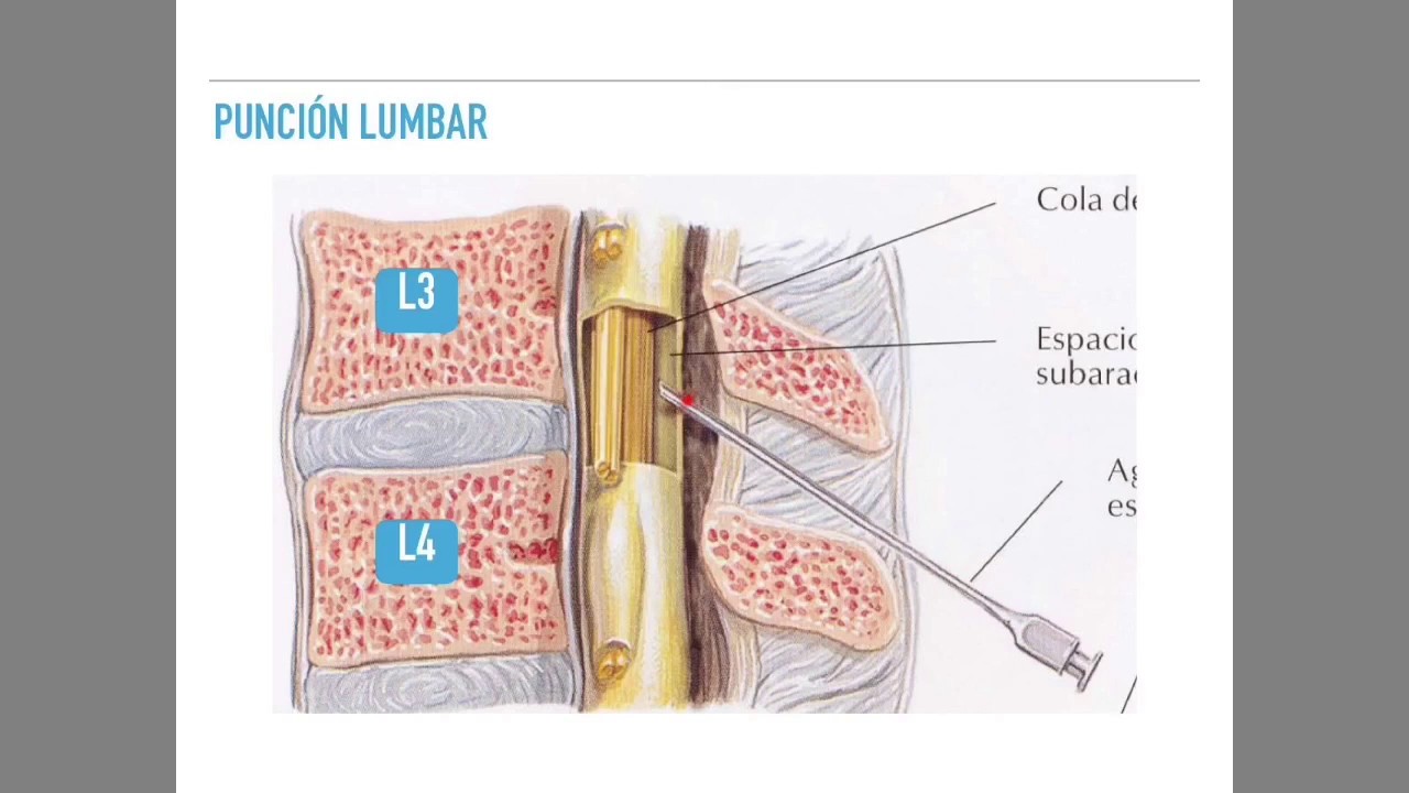 Punción lumbar y análisis de LCR