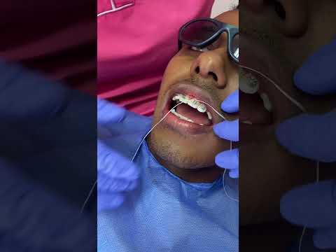 ¿Cómo evitar el sangrado de la encía y como usar el hilo dental cuando tenemos Brakets?