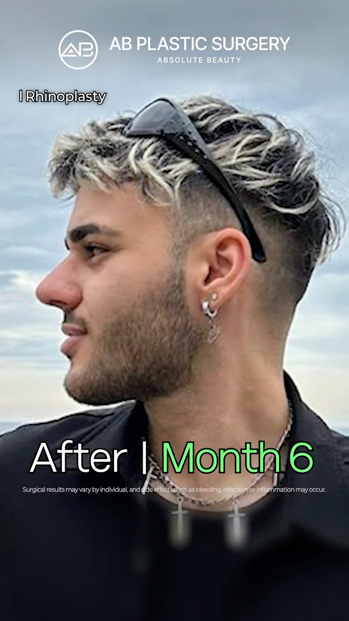 He Got Even More Handsome After Rhinoplasty