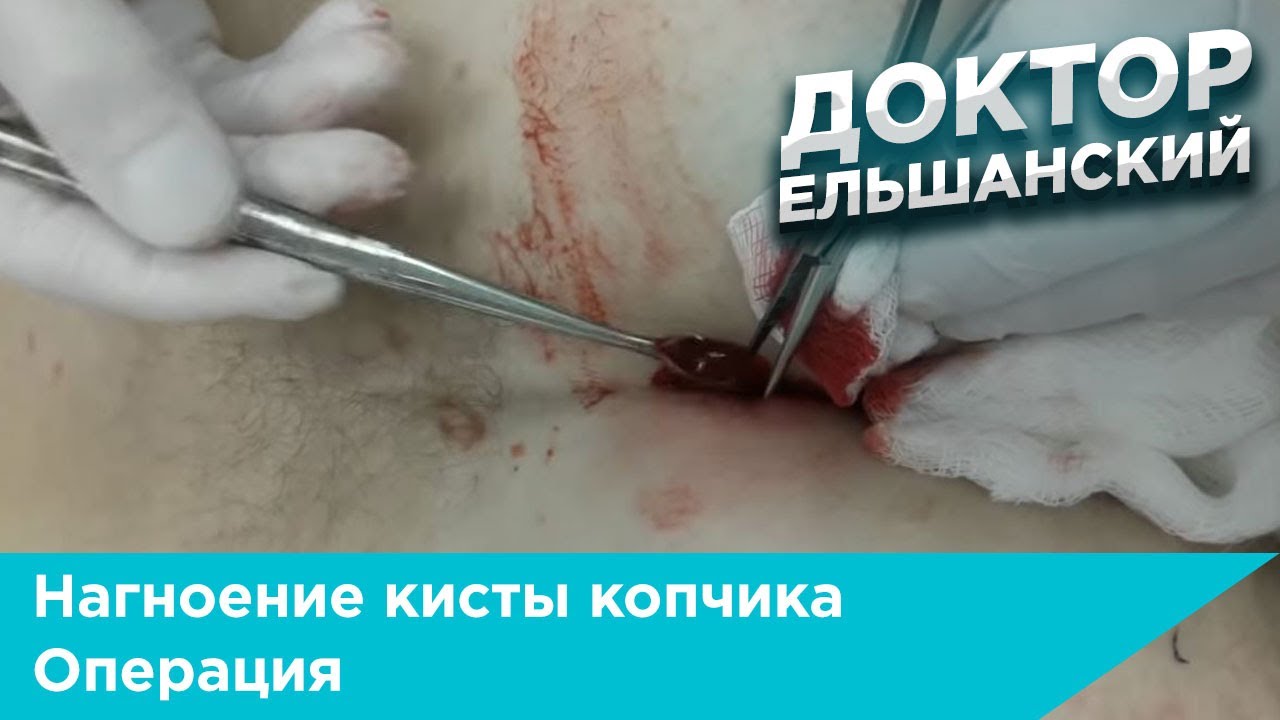 Нагноение кисты копчика операция