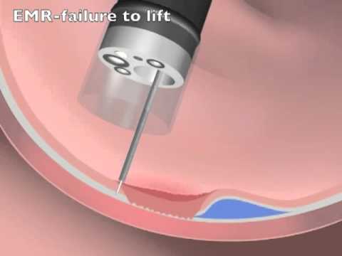 EMR - Lifting of the Lesion