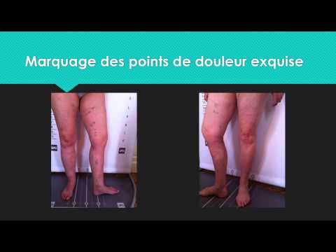 comment soulager contracture musculaire cuisse