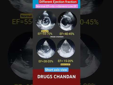 Normal to severe Low Ejection fraction Echo l EF 15-20% #echo #heartattack  #shorts