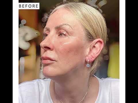 Look at Jayne's amazing results - 10 days after  Morpheus8