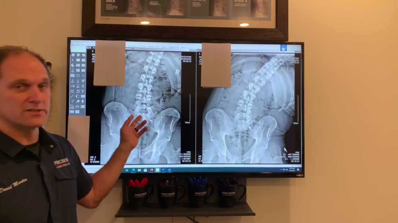 Before and After - Lower Back Xray