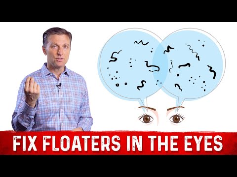 How To Get Rid of Eye Floaters – Dr Berg On Eye Floater Treatment