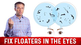 Fix Floaters in the Eyes