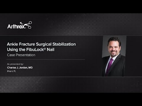 Ankle Fracture Surgical Stabilization Using the FibuLock® Nail